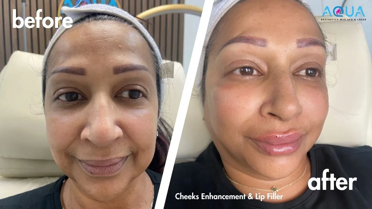 Cheeks Enhancement & Lip Filler — Aqua Aesthetics Med Spa Edmonton