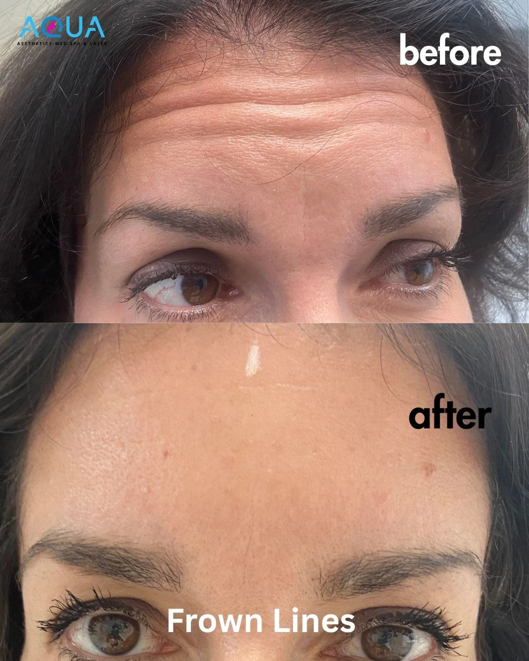 Frown Lines — Aqua Aesthetics Med Spa Edmonton