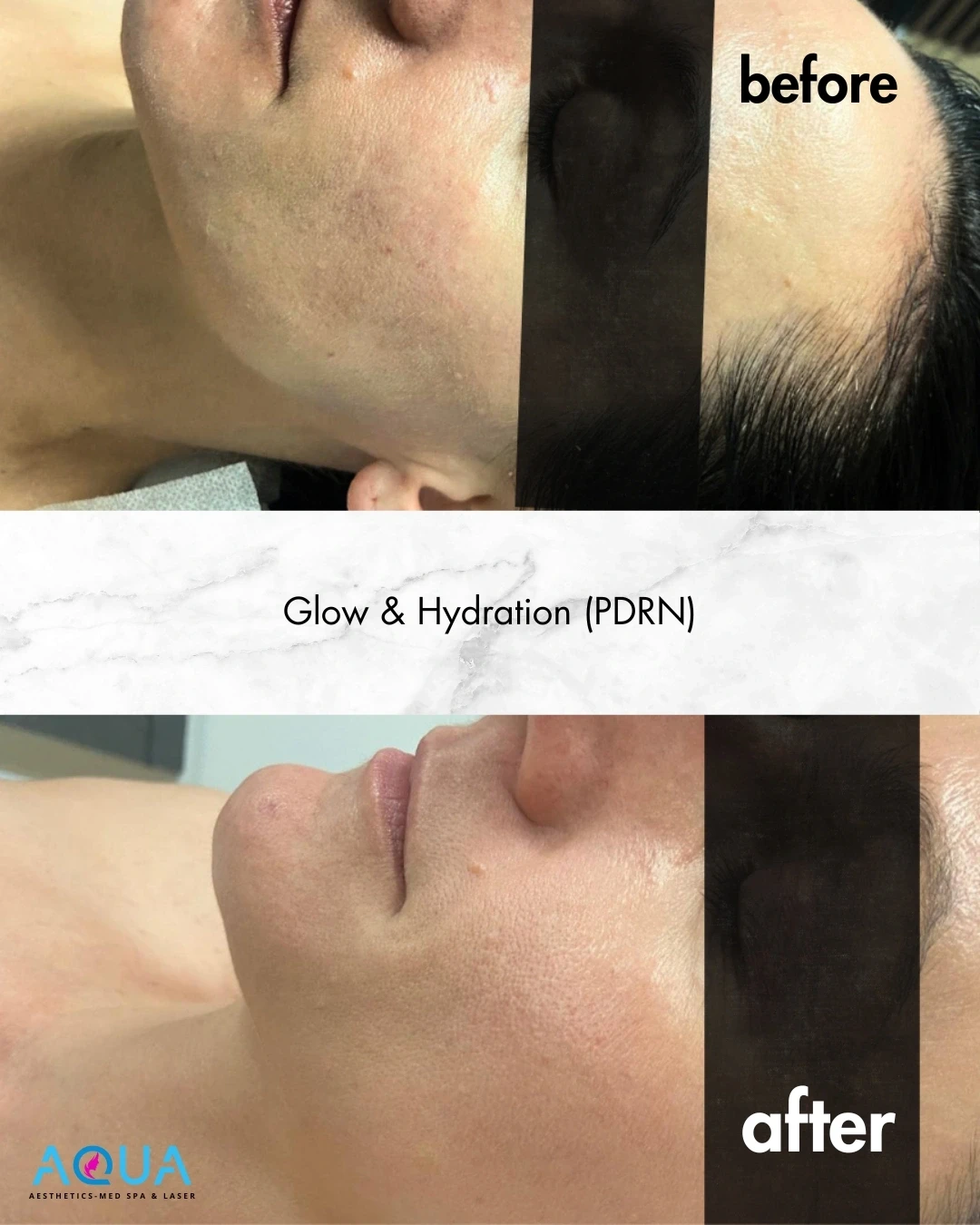 Injectables - PDRN — Aqua Aesthetics Med Spa Edmonton