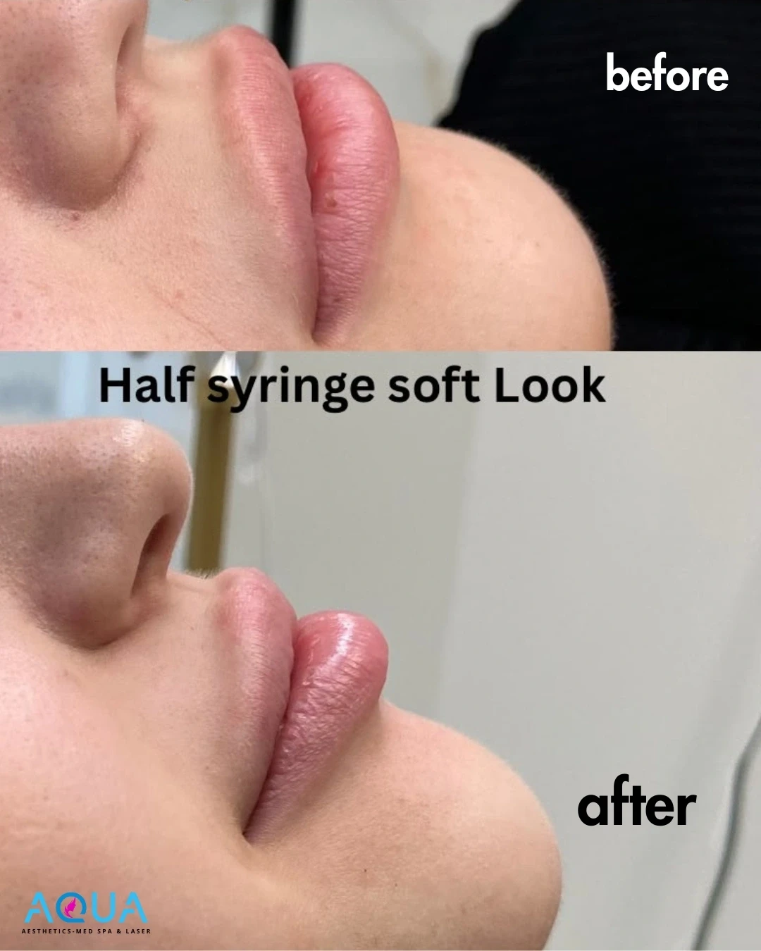 Lip Filler - Half Syringe Soft Look — Aqua Aesthetics Med Spa Edmonton