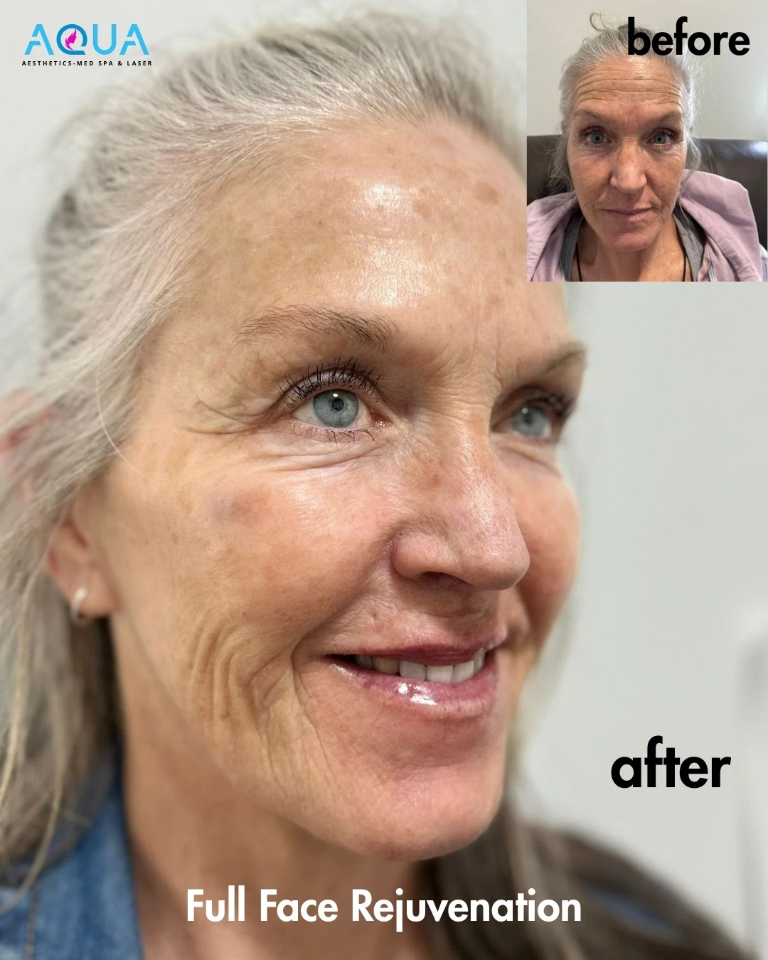 Full Face Rejuvenation — Aqua Aesthetics Med Spa Edmonton