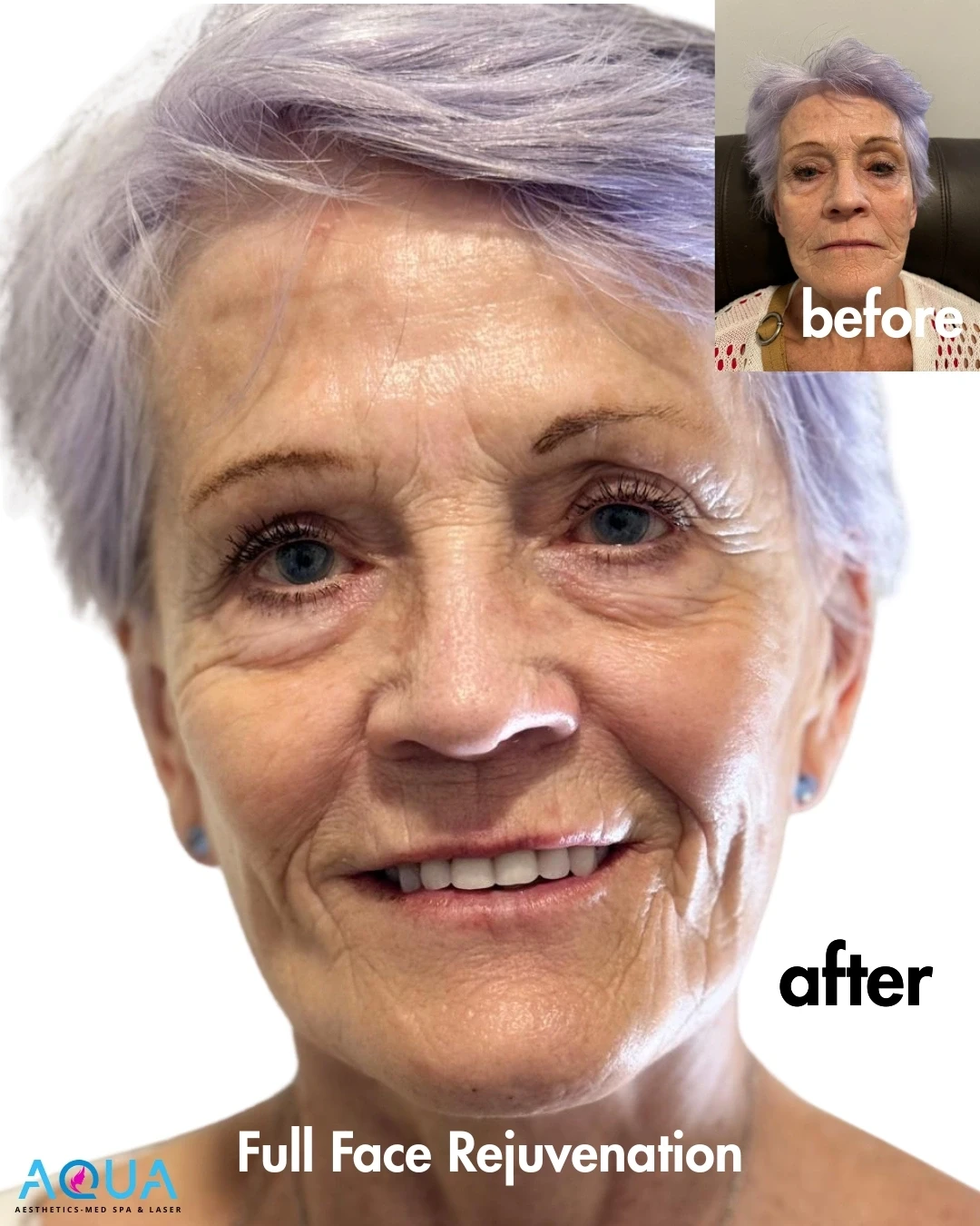 Full Face Rejuvenation — Aqua Aesthetics Med Spa Edmonton