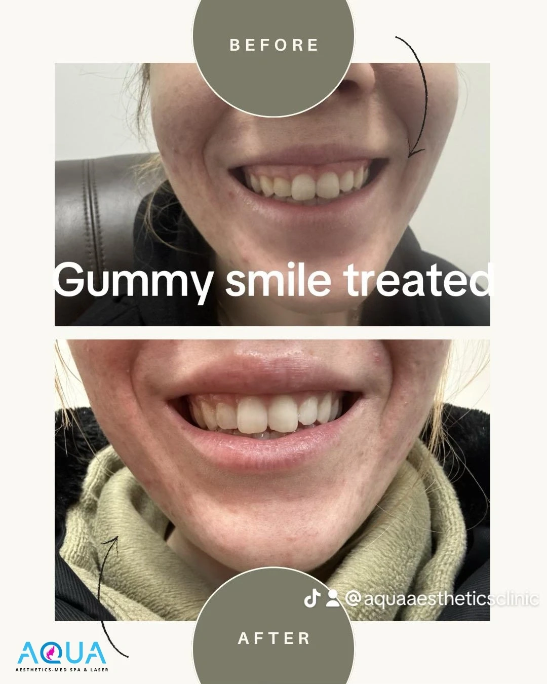 Gummy Smile Treatment — Aqua Aesthetics Med Spa Edmonton