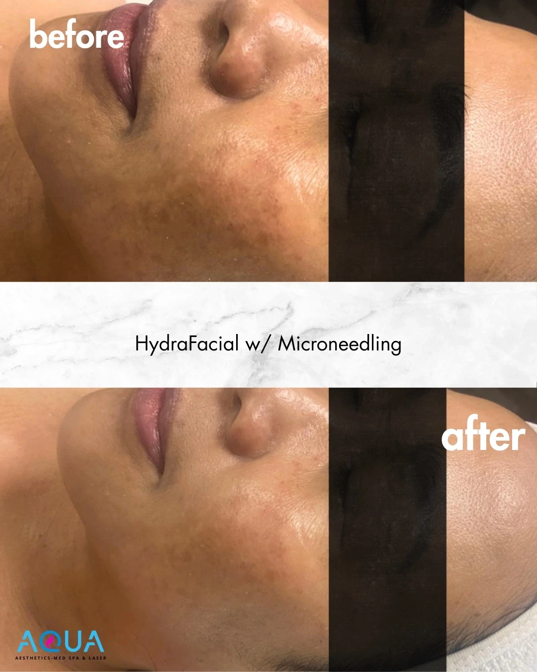 HydraFacial w/ Microneedling — Aqua Aesthetics Med Spa Edmonton