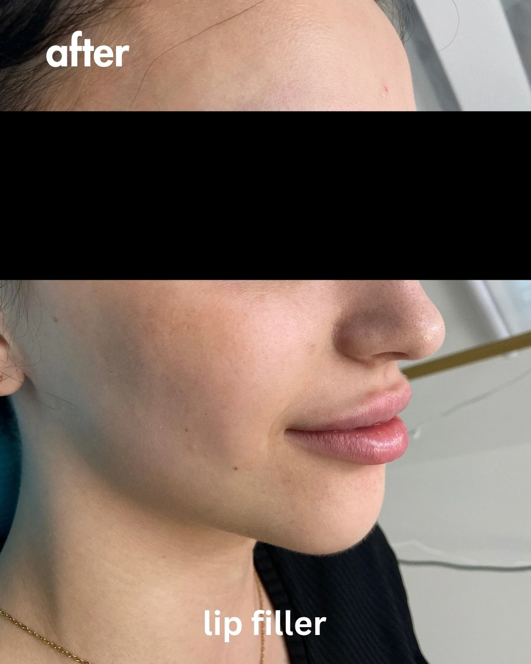 Lip Filler — Aqua Aesthetics Med Spa Edmonton