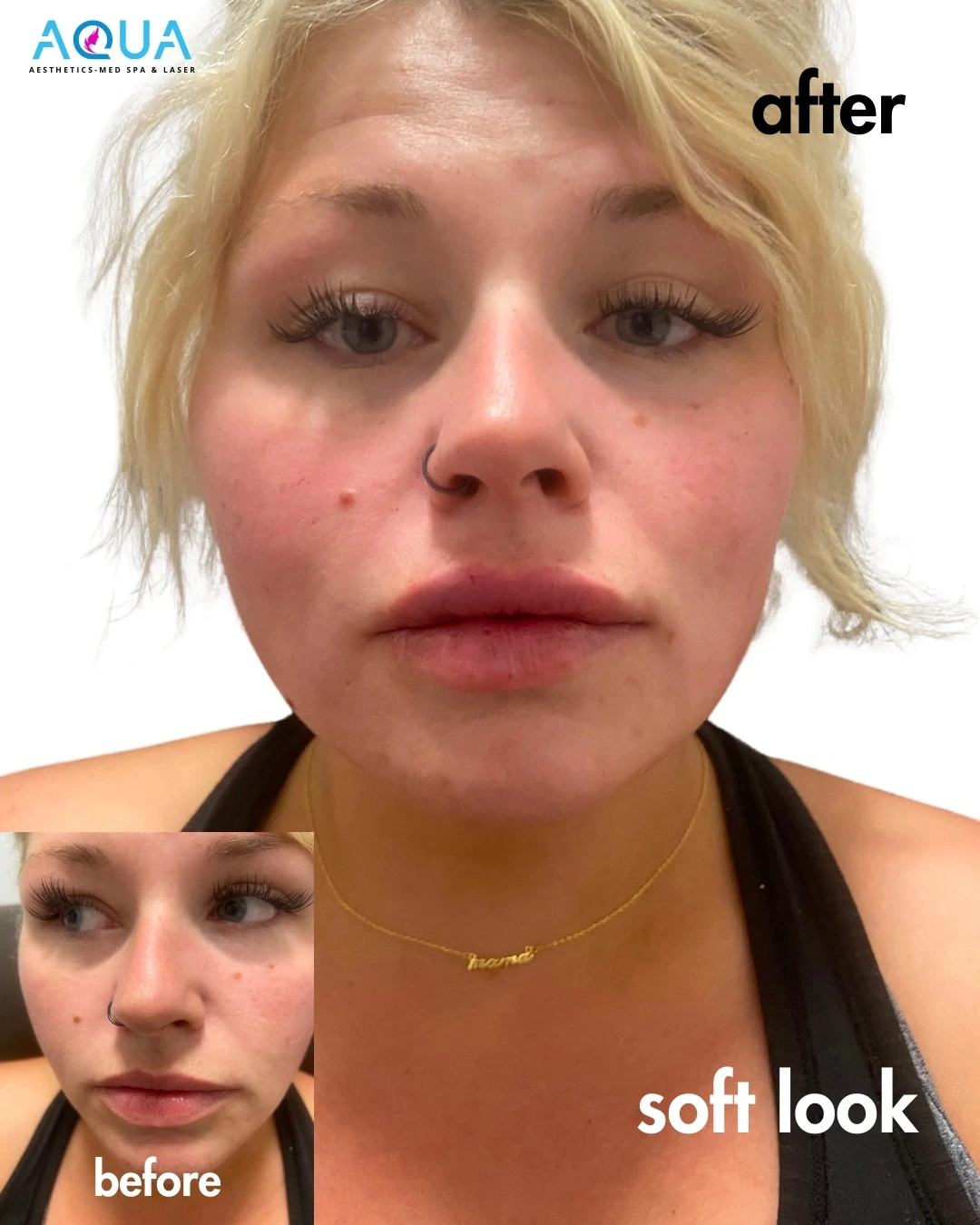 Lip Filler - Soft Look — Aqua Aesthetics Med Spa Edmonton