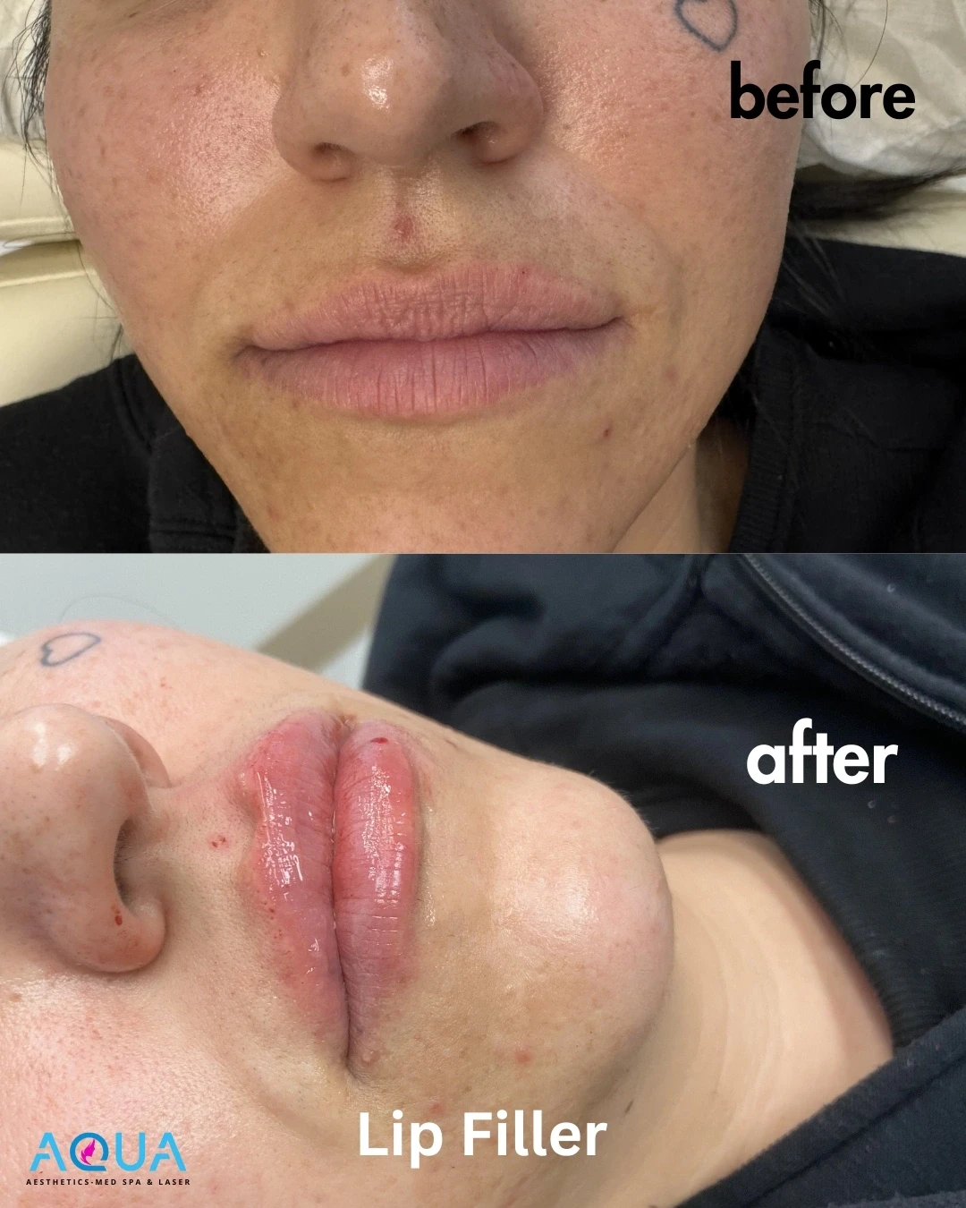 Lip Filler — Aqua Aesthetics Med Spa Edmonton