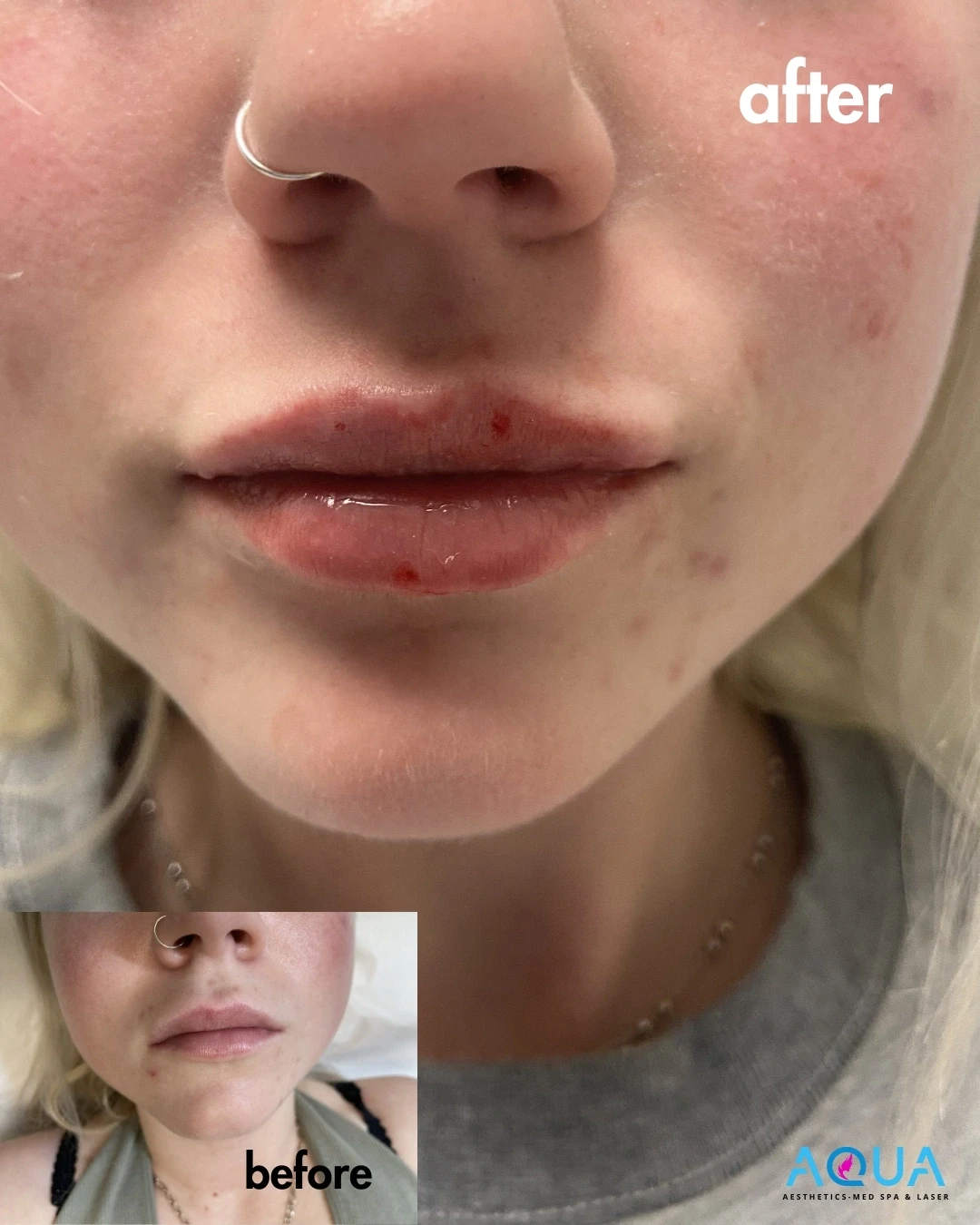 Lip Filler — Aqua Aesthetics Med Spa Edmonton