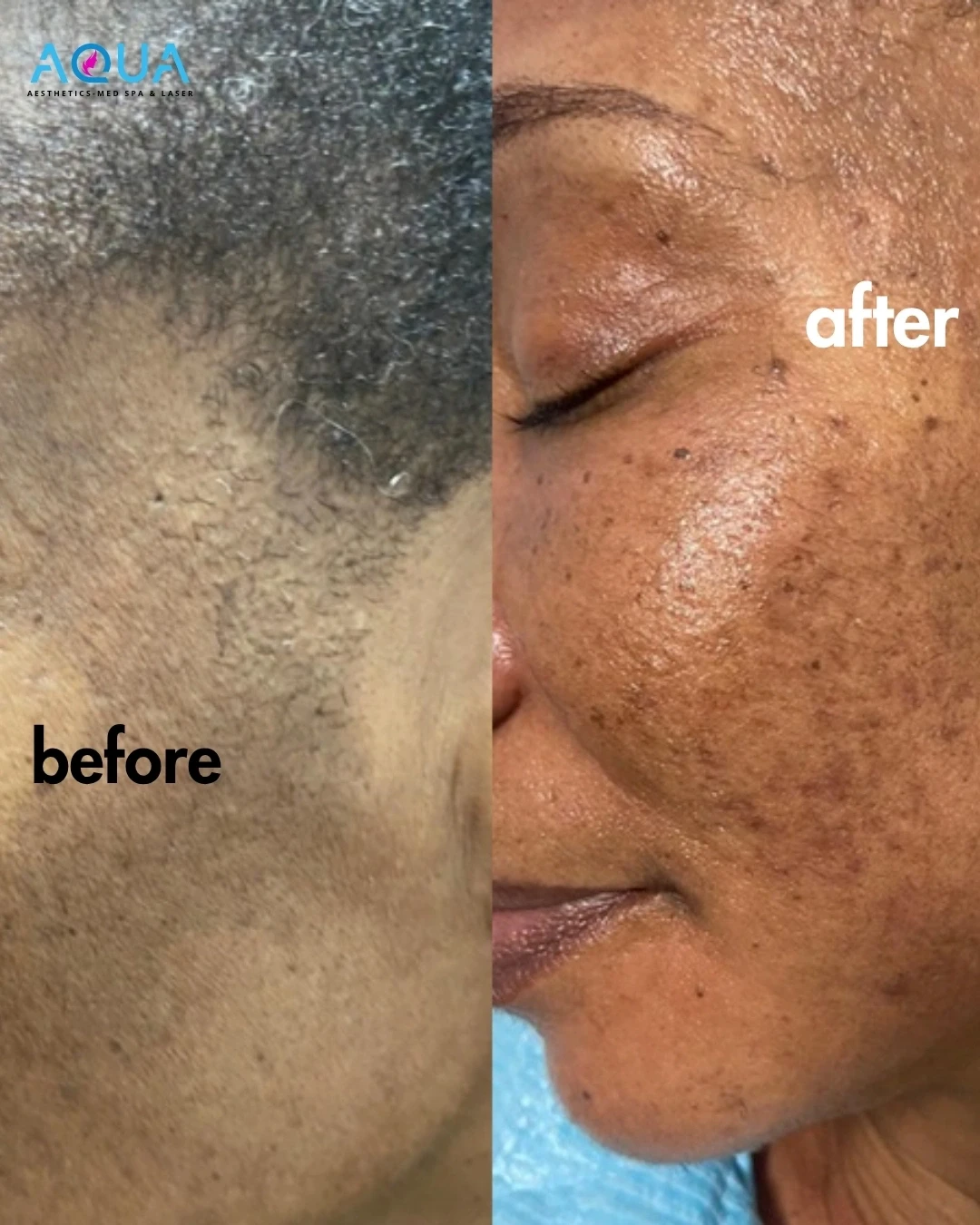 Melasma Treatment — Aqua Aesthetics Med Spa Edmonton