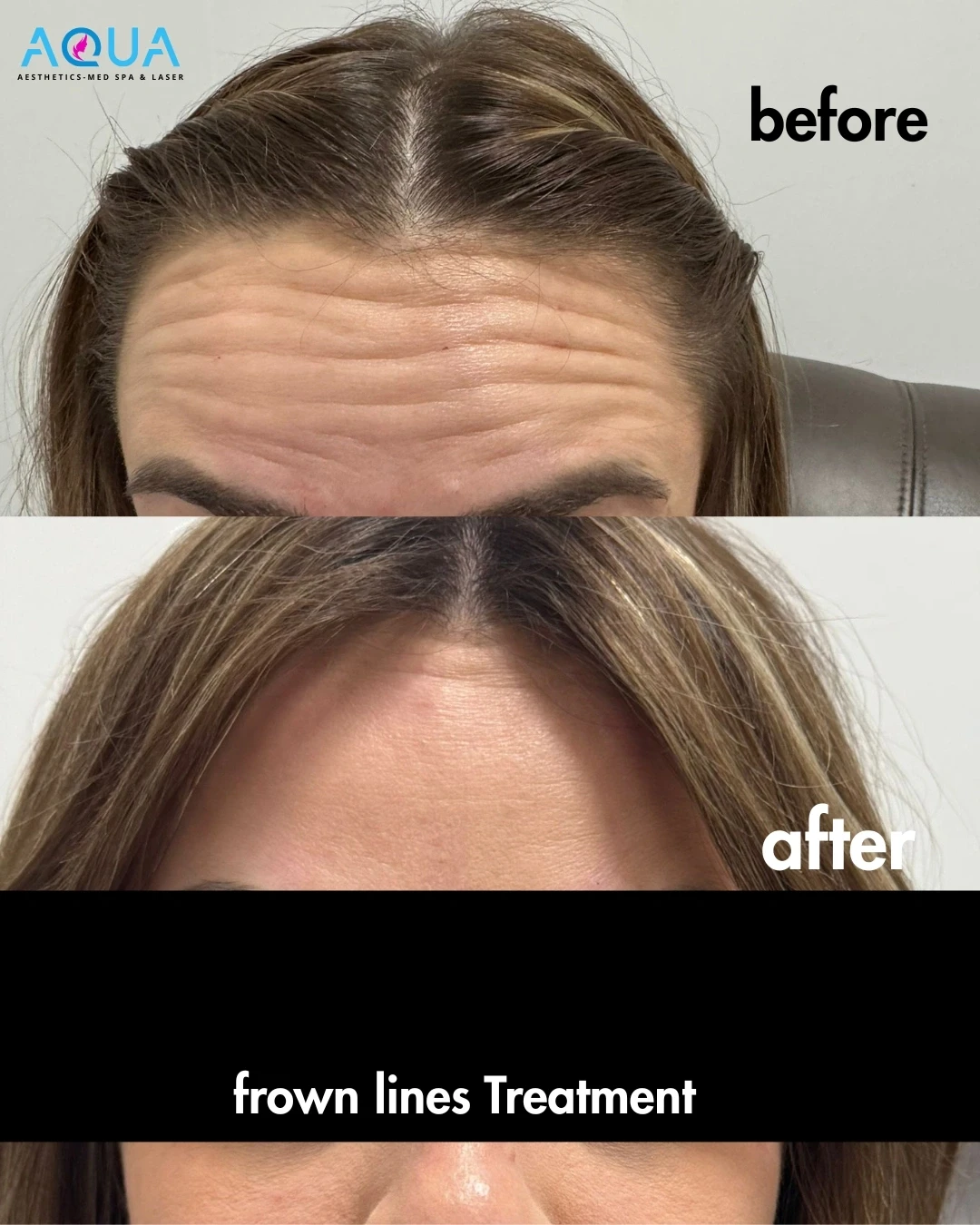 Botox - Frown Lines Treatment — Aqua Aesthetics Med Spa Edmonton