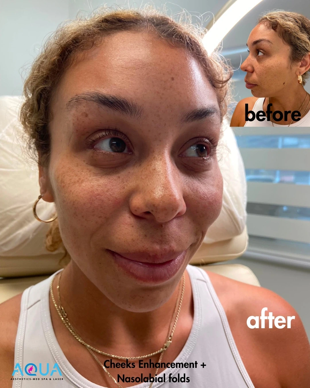 Cheeks Enhancement + Nasolabial Folds — Aqua Aesthetics Med Spa Edmonton