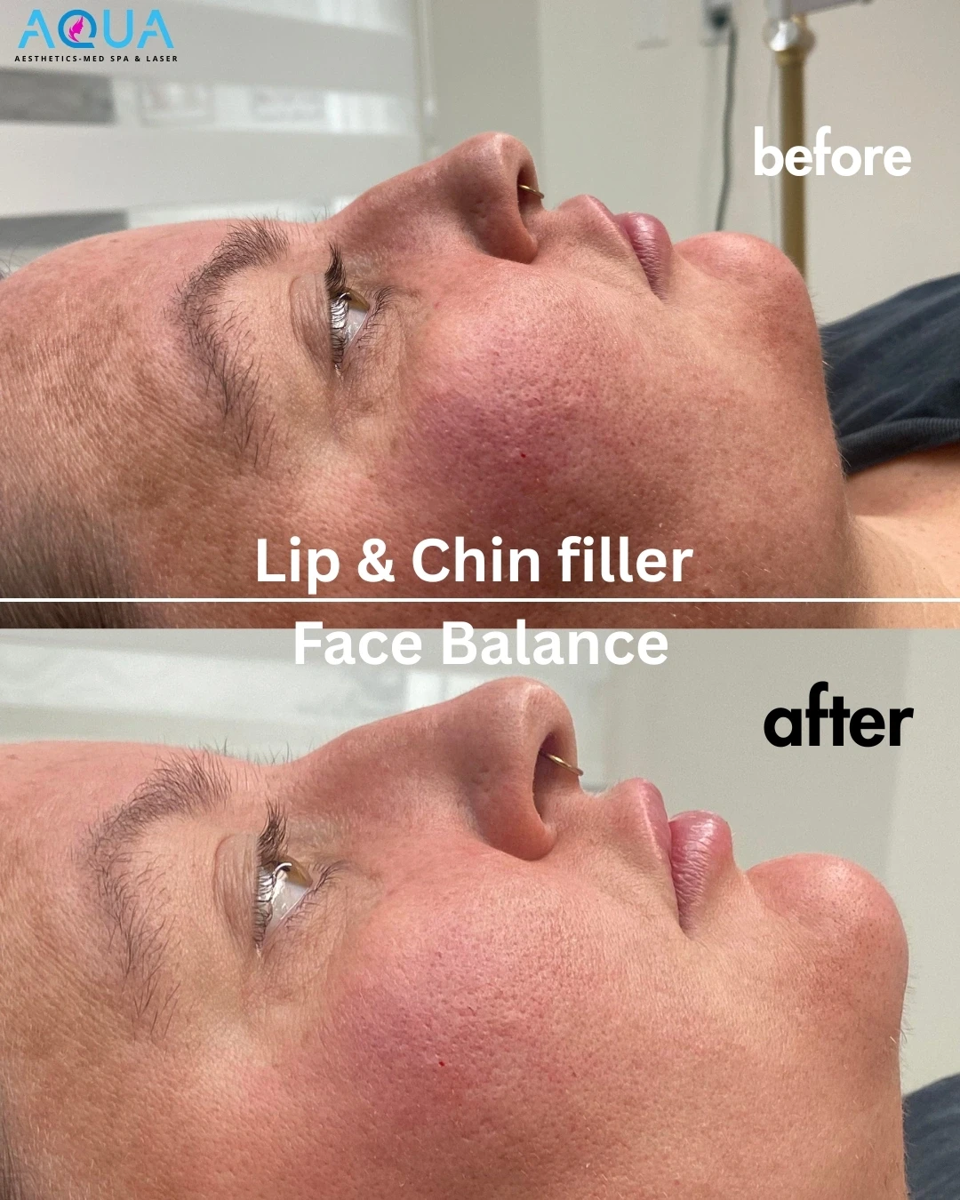 Lip & Chin Filler - Face Balance — Aqua Aesthetics Med Spa Edmonton