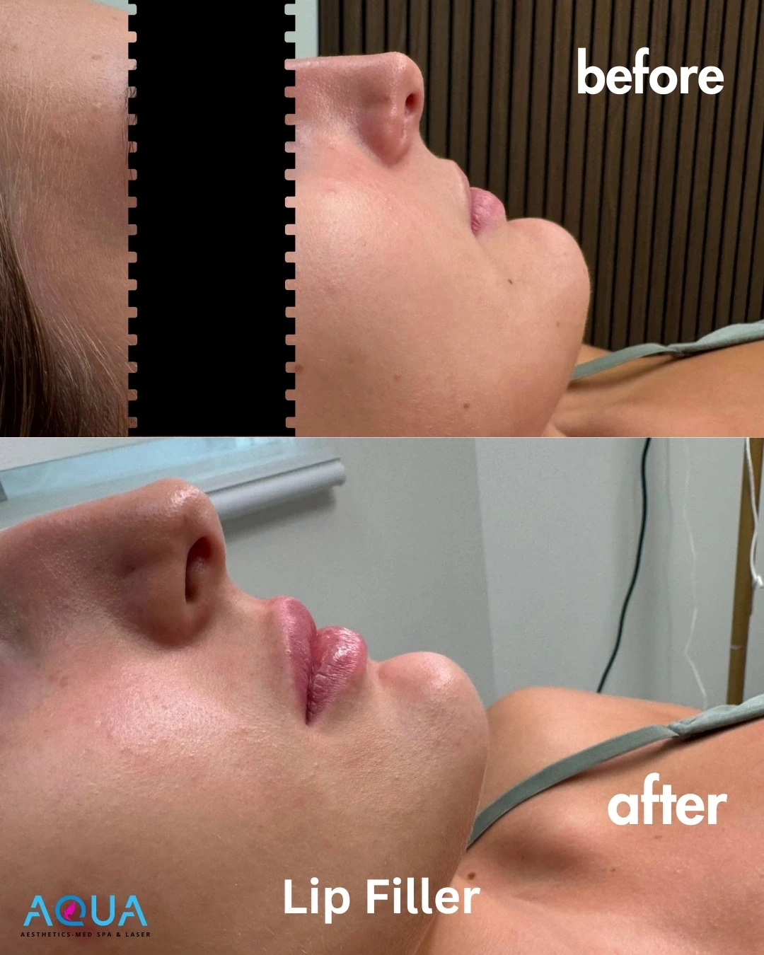 Lip Filler — Aqua Aesthetics Med Spa Edmonton