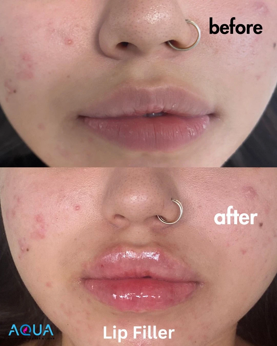 LIP FILLERS — Aqua Aesthetics Med Spa Edmonton